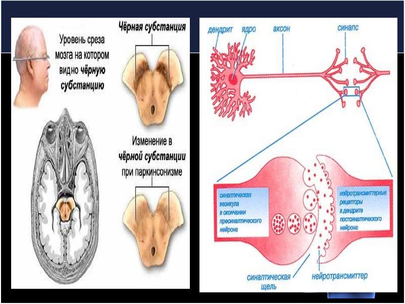 Паркинсон ауруы презентация