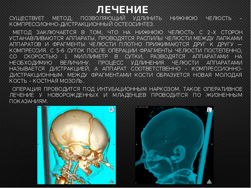 Синдром пьера робена фото