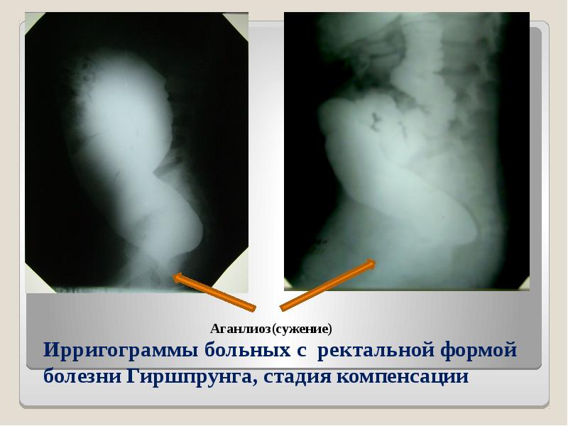 Клиническая картина ректальной формы болезни гиршпрунга характеризуется