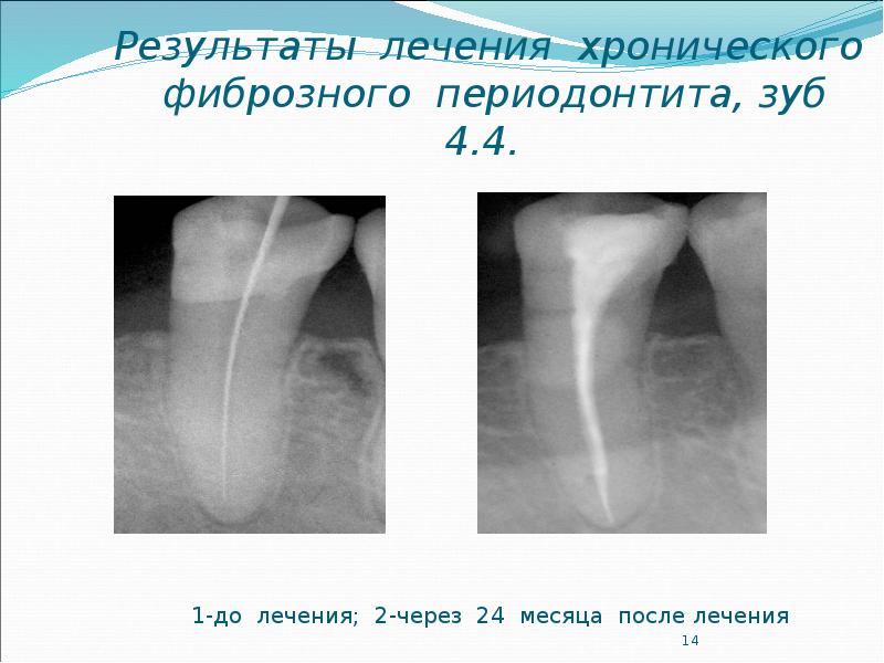 Планирование и подготовка к лечению апикального периодонтита презентация