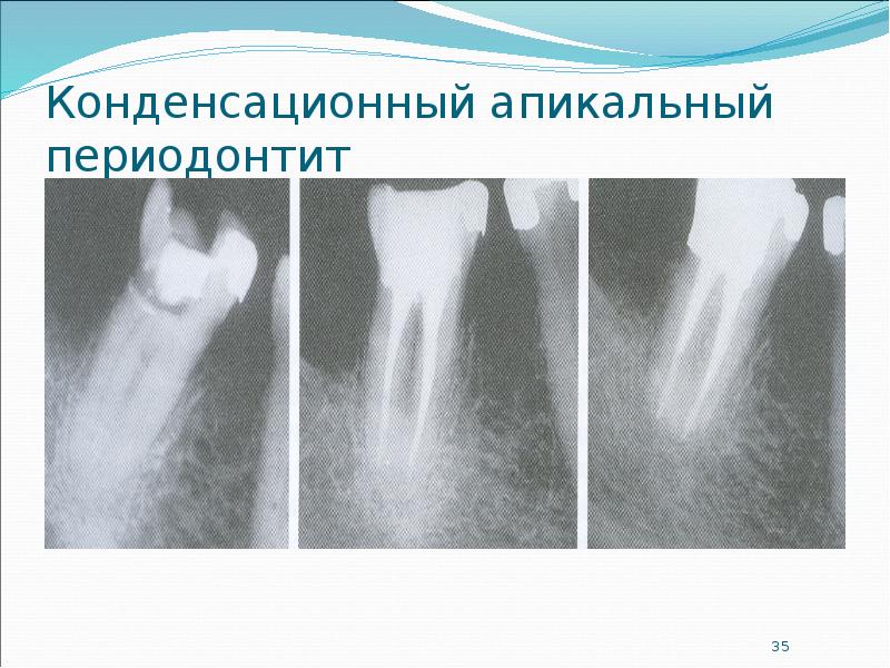 Планирование и подготовка к лечению апикального периодонтита презентация