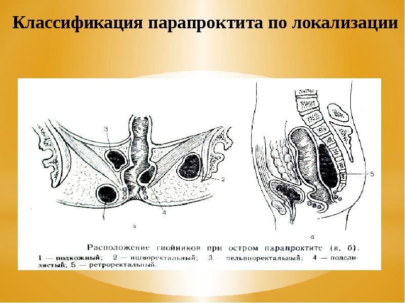 Клиническая картина парапроктита