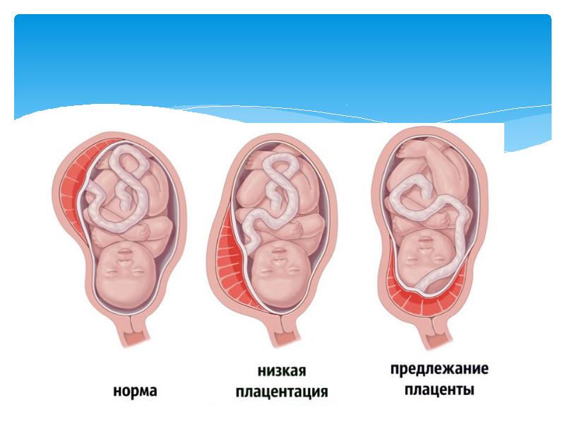 Предлежание плаценты картинки