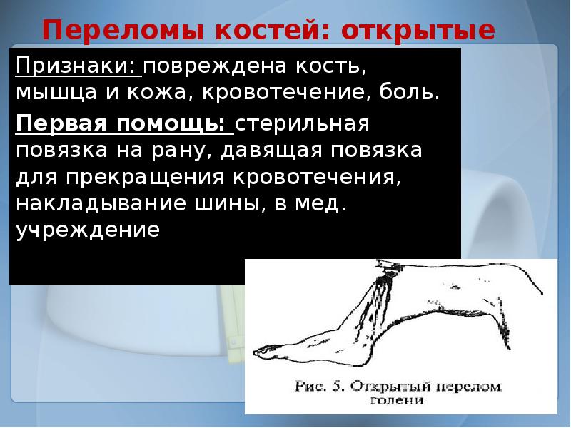 Признаки открытого перелома конечностей. Открытый перелом признаки. Признаки перелома костей открытые. Признаки открытого перелома. Открытые переломы симптомы.