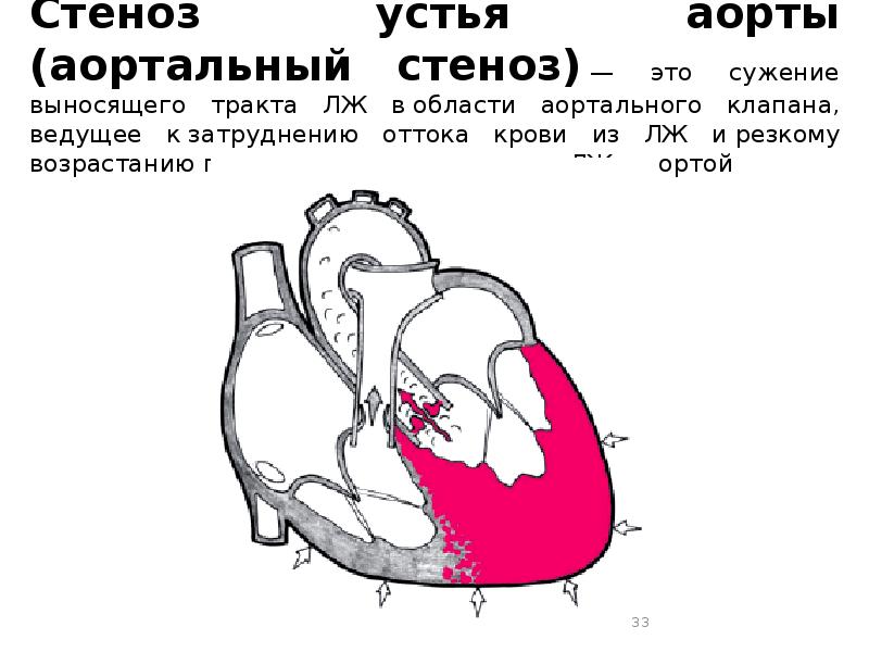 Аортальный стеноз презентация