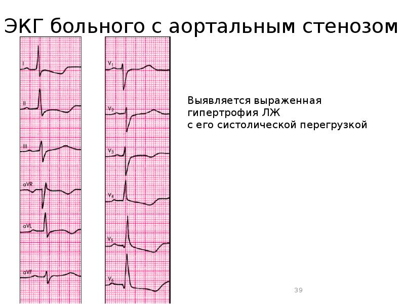 Аортальные пороки презентация