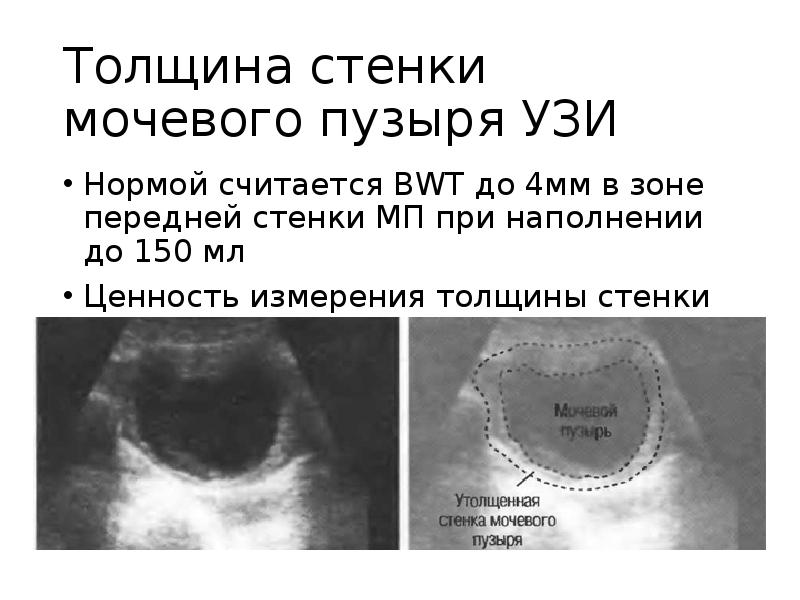 Узи остаточной мочи. Толщина стенки мочевого пузыря УЗИ. УЗИ мочевого пузыря показатели в норме. УЗИ мочевого пузыря нормативы. Объем мочевого пузыря на УЗИ норма.