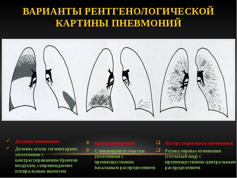 Рентгенологическая картина пневмонии