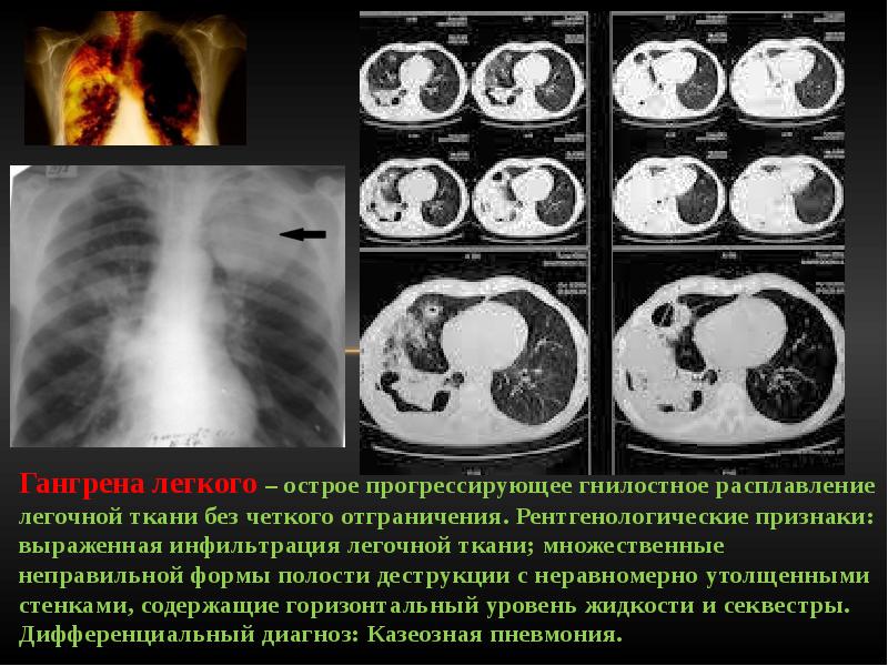 Лучевая диагностика синдрома инфильтрации легочной ткани презентация