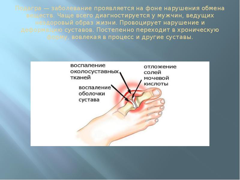 Подагра психосоматика синельников. Подагра презентация патофизиология. Подагра психосоматика. Вторичная подагра развивается при. Выведение солей мочевой кислоты из суставов народными средствами.