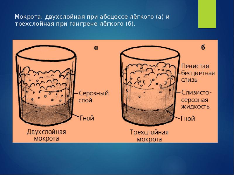 Мокрота при каше на