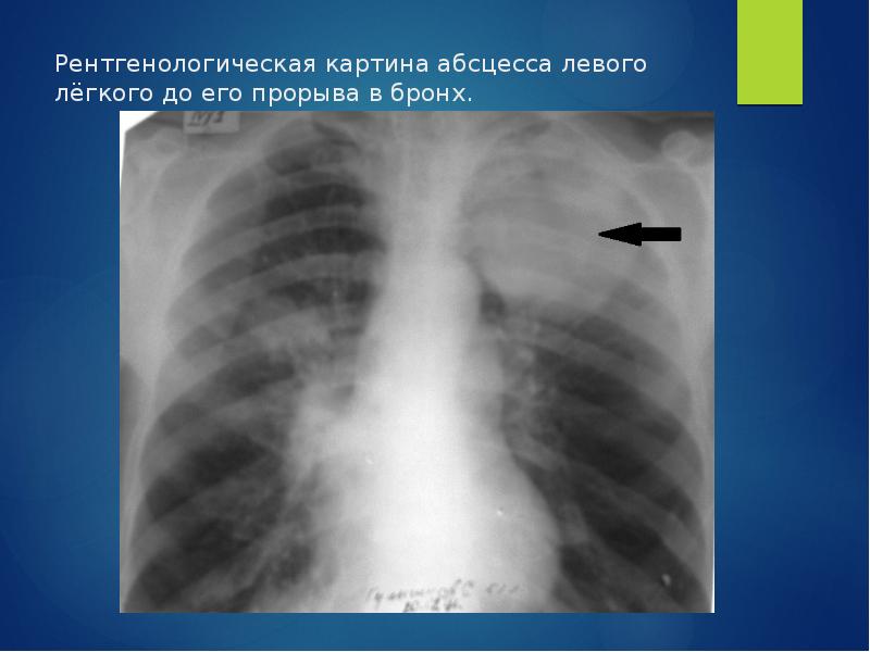 Рентгенологическая картина при абсцессе