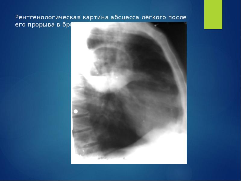 Рентгенологическая картина при абсцессе