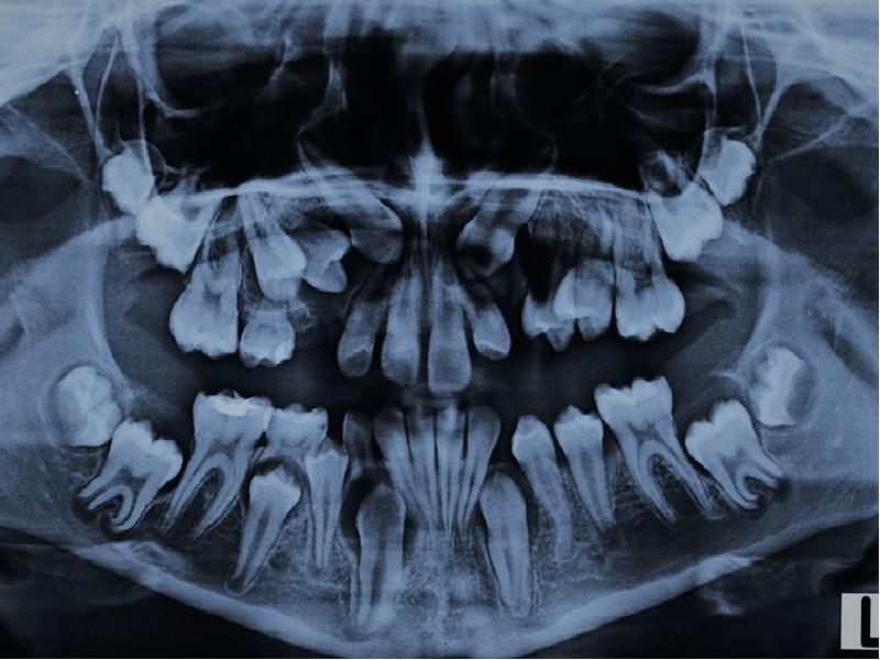 Ретенирование зуба. Ретинированный дистопированный зуб. Ретинированный клык ОПТГ.