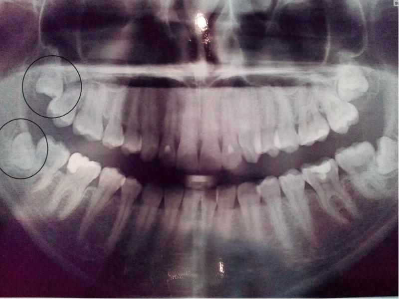 Болезни прорезывания зубов, Дистопия, Ретенция