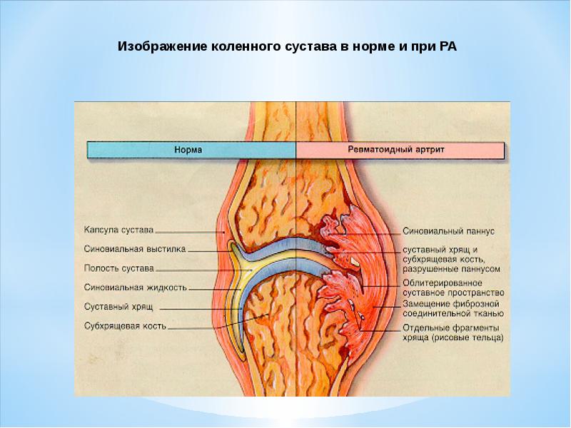 Ревматоидты артрит қазақша презентация