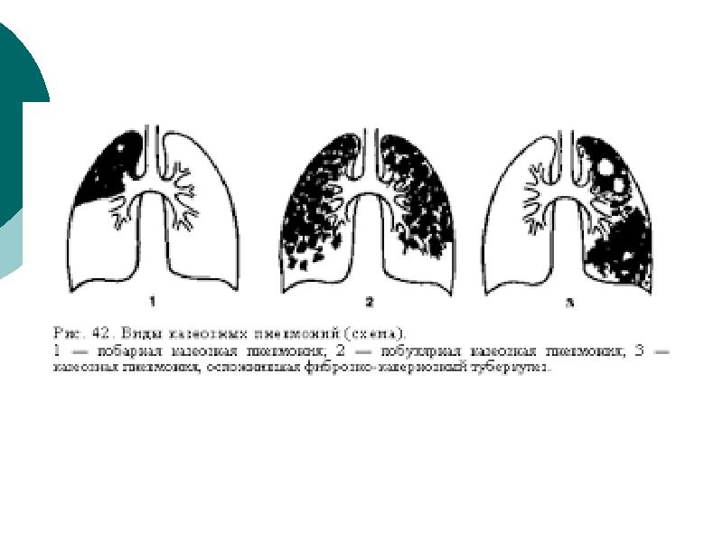 Казеозная пневмония фтизиатрия презентация