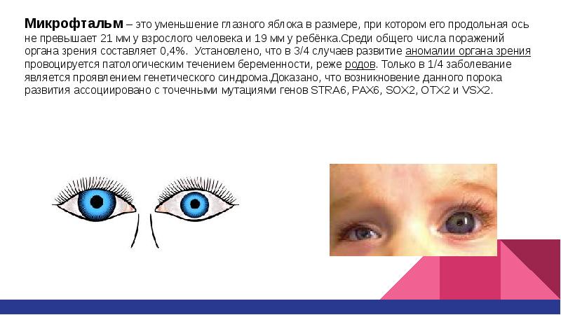 триада горнера птоз миоз энофтальм. хламидийный конъюнктивит паратрахома. тату на глазном яблоке фото. энофтальм (западение глазного яблока). субатрофия глазного яблока.