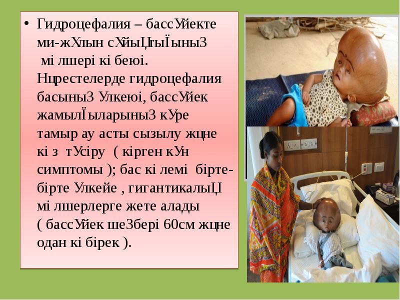 Гидроцефалия – бассүйекте ми-жұлын сұйықтығының мөлшері көбеюі. Нәрестелерде гидроцефалия басының үлкеюі, Гидроцефалия – бассүйекте ми-жұлын сұйықтығының мөлшері көбеюі. Нәрестелерде гидроцефалия басының үлкеюі,
