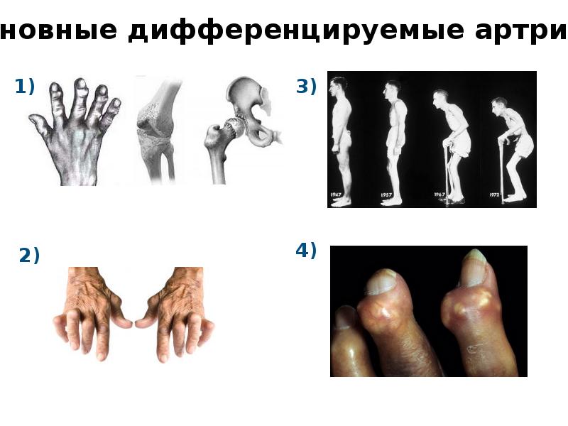 Суставной синдром презентация