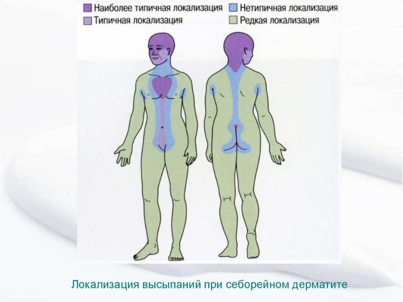 Себорейный дерматит презентация