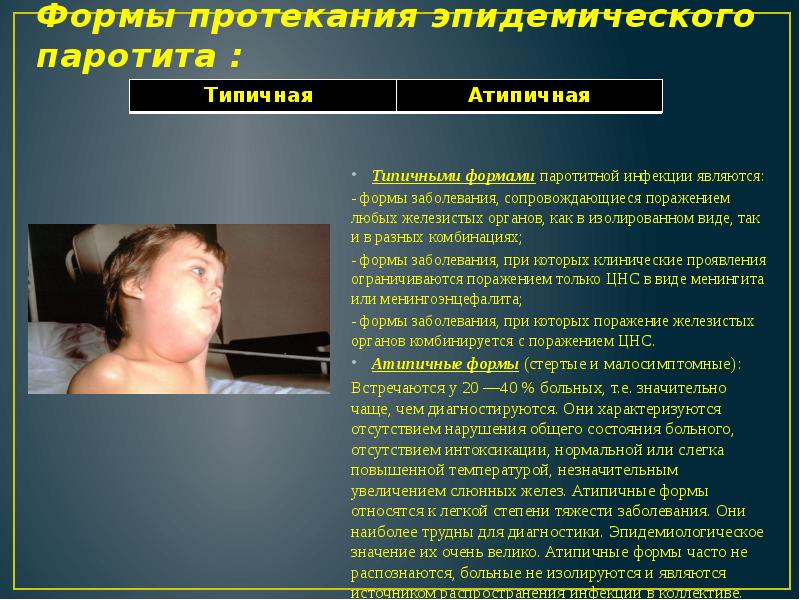Формы протекания эпидемического паротита :     Типичными формами