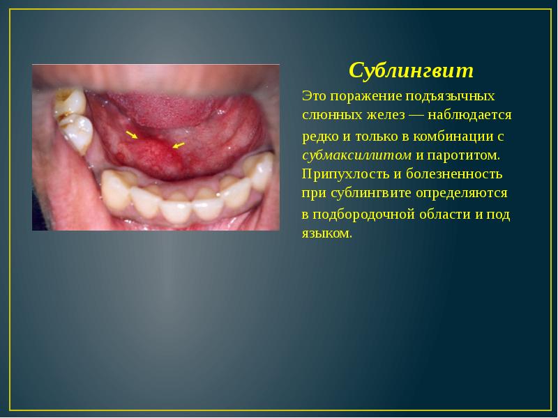 Сублингвит  Сублингвит  Это поражение подъязычных слюнных желез — наблюдается