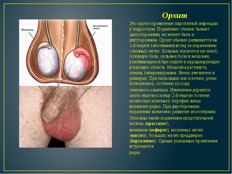 Орхит Орхит Это частое проявление паротитной инфекции у подростков. Поражение обычно