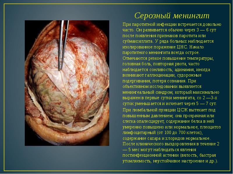 Серозный менингит Серозный менингит При паротитной инфекции встречается довольно часто. Он