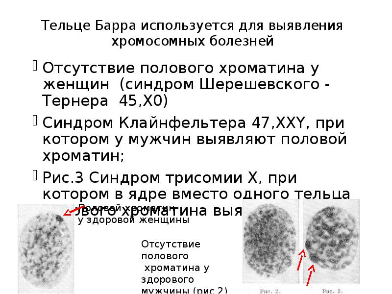 Синдром шерешевского тернера тельце барра