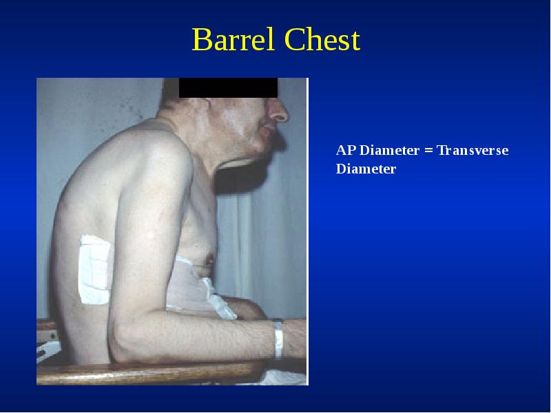 Barrel Chest Barrel Chest