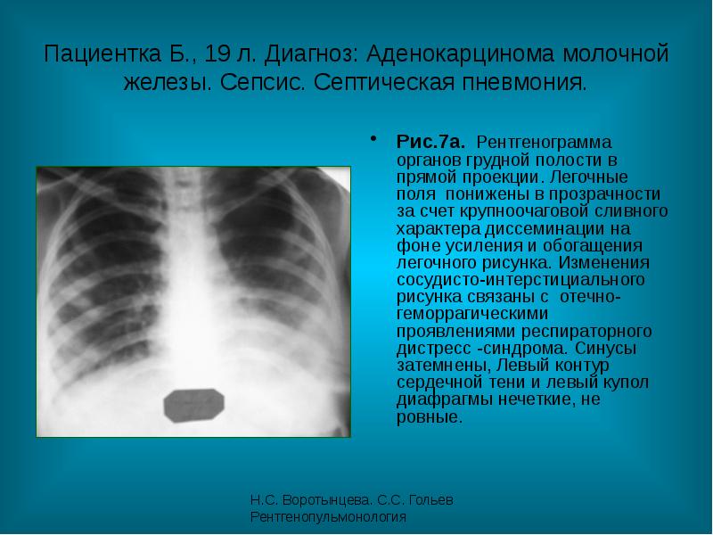 Интерстициальное заболевание легких - European Lung Foundation