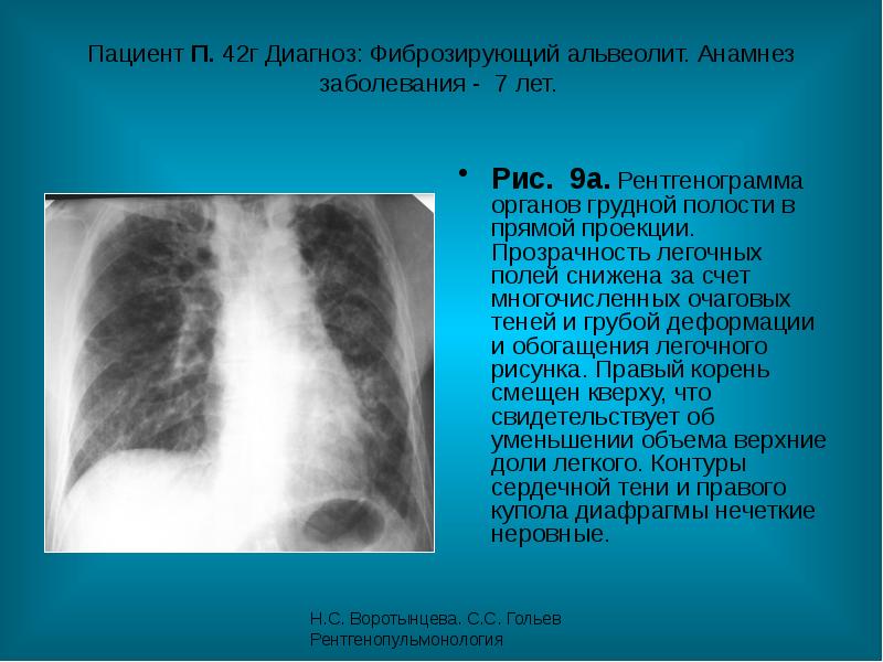 Альвеолиты легких презентация