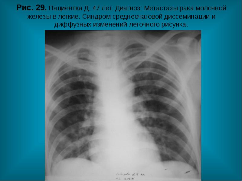 Рестриктивные болезни легких. Симптомы онкологии легких у женщин на ранних стадиях. Диффузный рак легких что это. Диффузный рак легких что это. Обструктивные и рестриктивные заболевания легких презентация.