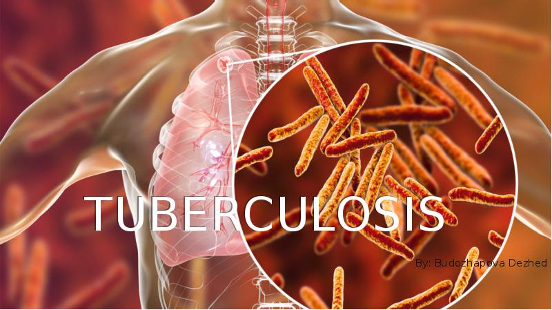 TUBERCULOSIS
 By: Budozhapova Dezhed TUBERCULOSIS
 By: Budozhapova Dezhed