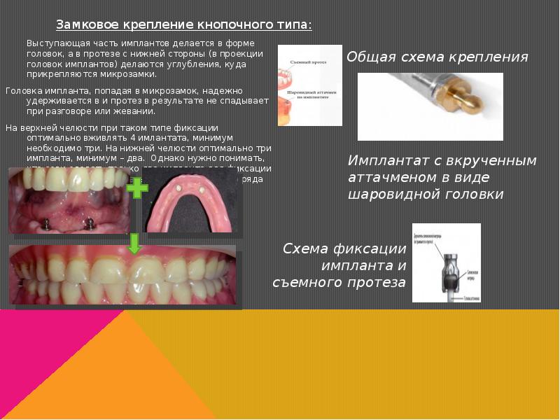 Анатомические предпосылки стоматологической имплантации презентация