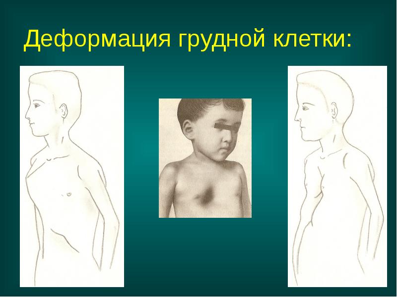 Деформация грудной клетки: Деформация грудной клетки:
