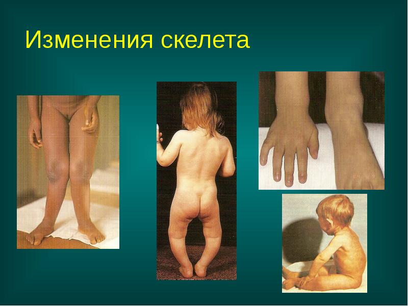 Изменения скелета Изменения скелета