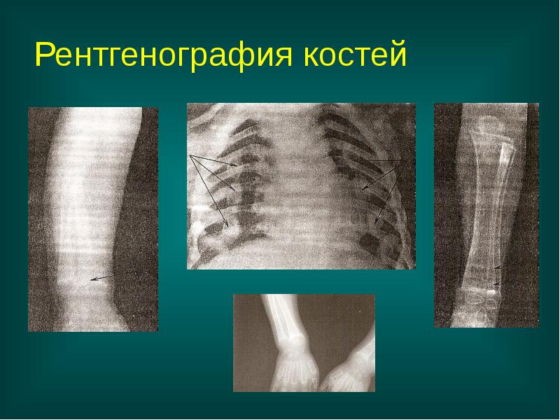 Рентгенография костей Рентгенография костей
