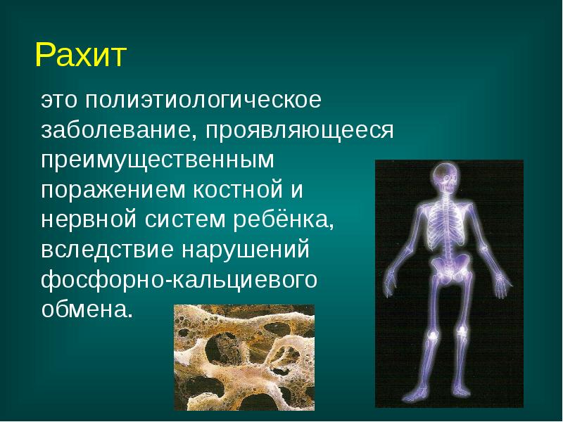 Рахит
это полиэтиологическое заболевание, проявляющееся преимущественным поражением костной и нервной Рахит
это полиэтиологическое заболевание, проявляющееся преимущественным поражением костной и нервной