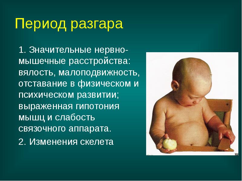 Период разгара
1. Значительные нервно-мышечные расстройства: вялость, малоподвижность, отставание в физическом Период разгара
1. Значительные нервно-мышечные расстройства: вялость, малоподвижность, отставание в физическом