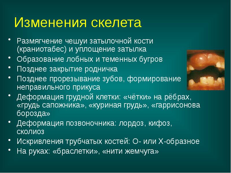 Гипервитаминоз д спазмофилия. Гипервитаминоз д презентация. Гипервитаминоз витамина в2.