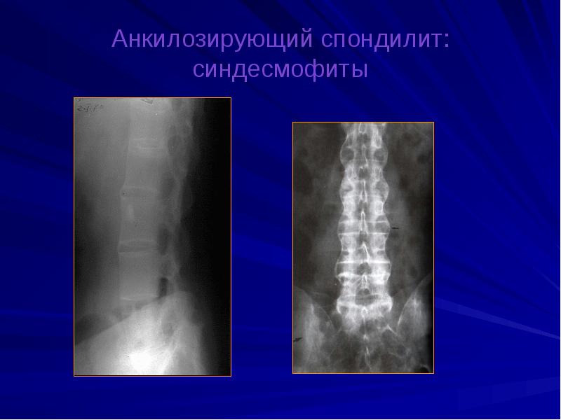 Анкилозирующий спондилит презентация