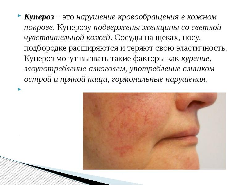 Купероз&nbsp;– это&nbsp;нарушение кровообращения в кожном покрове. Куперозу&nbsp;подвержены женщины со светлой чувствительной