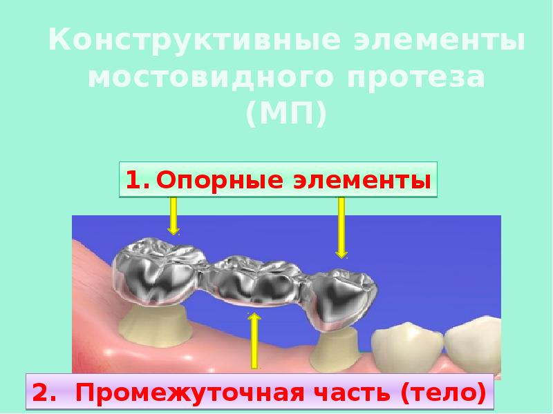 Цельнолитые коронки презентация