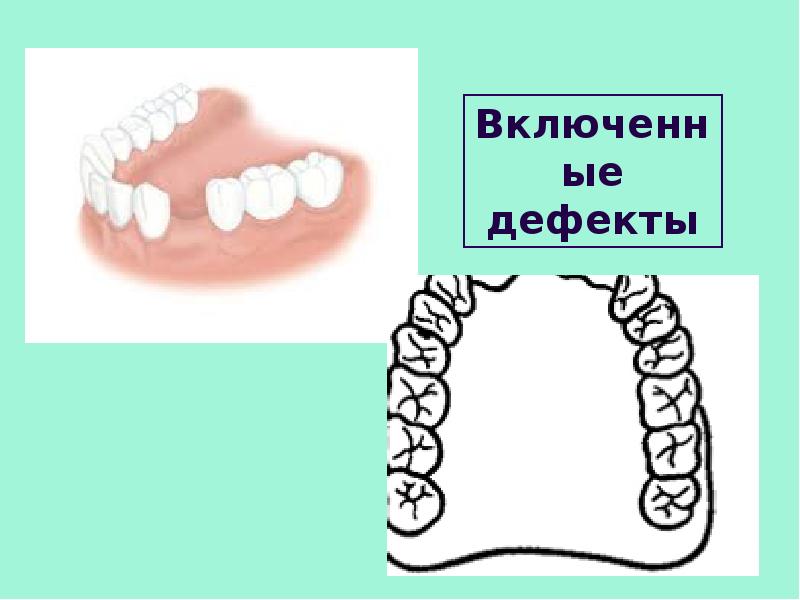 Наложение сложных шин и шин протезов презентация