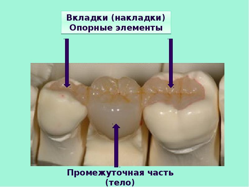 Адгезивный мостовидный протез что это такое фото