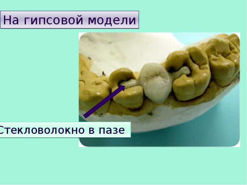 Мостовидные протезы презентация