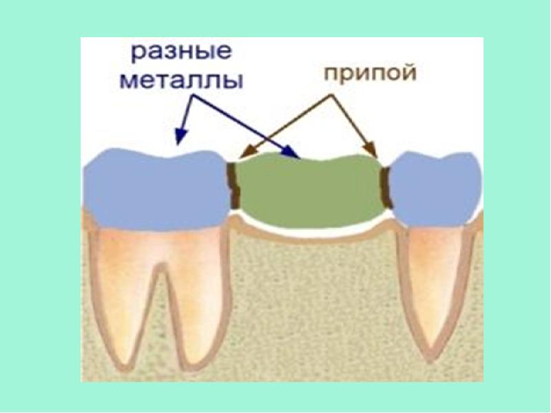 Адгезивные мостовидные протезы презентация