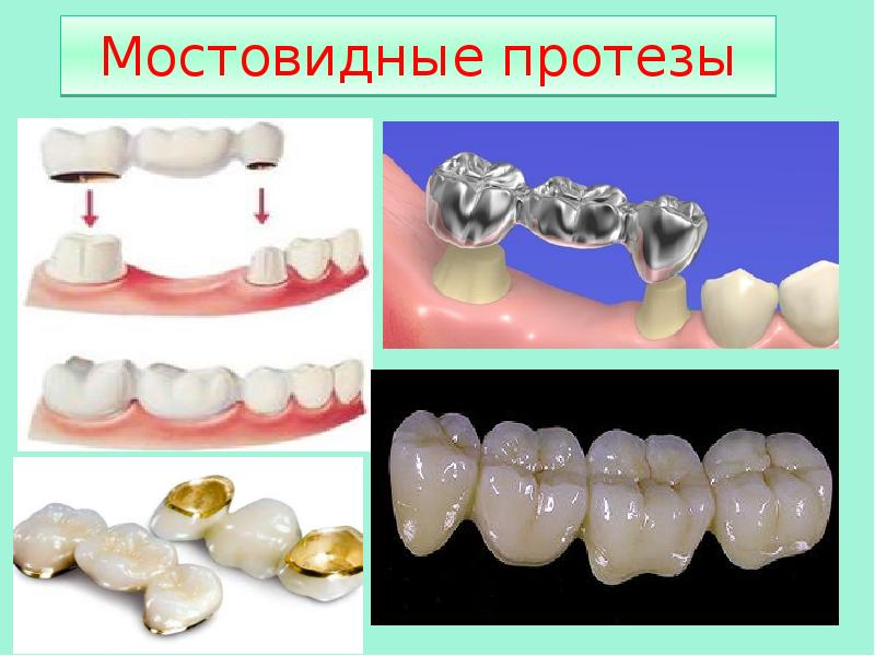 Цельнолитые коронки презентация